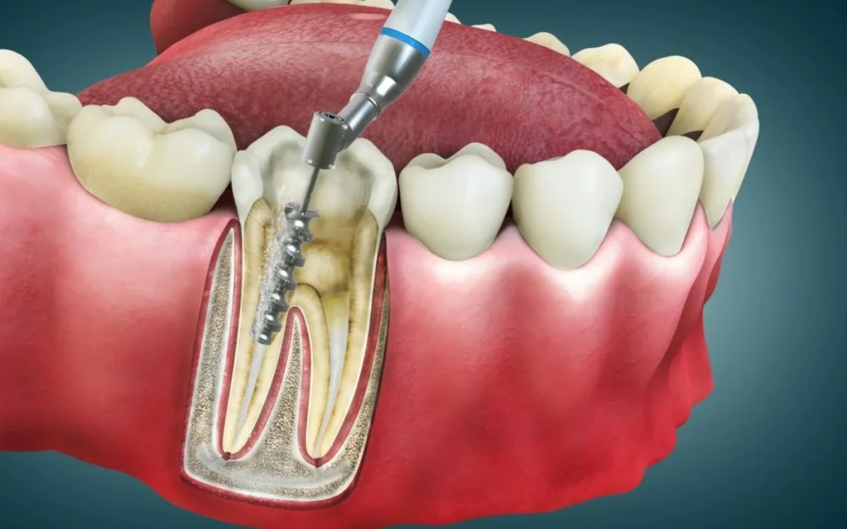 Root Canal Treatment