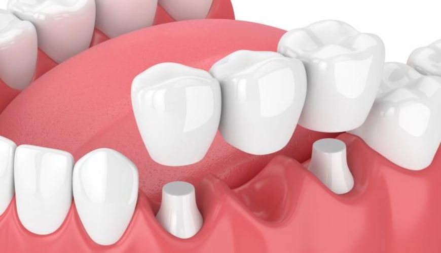 Dental Crowns and Bridges