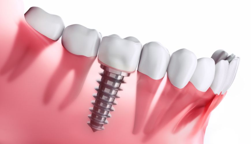 Dental Restorations