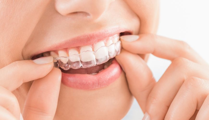 Composite Fillings